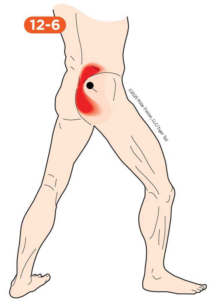 Glute Pain 12-6 Gluteus Medius