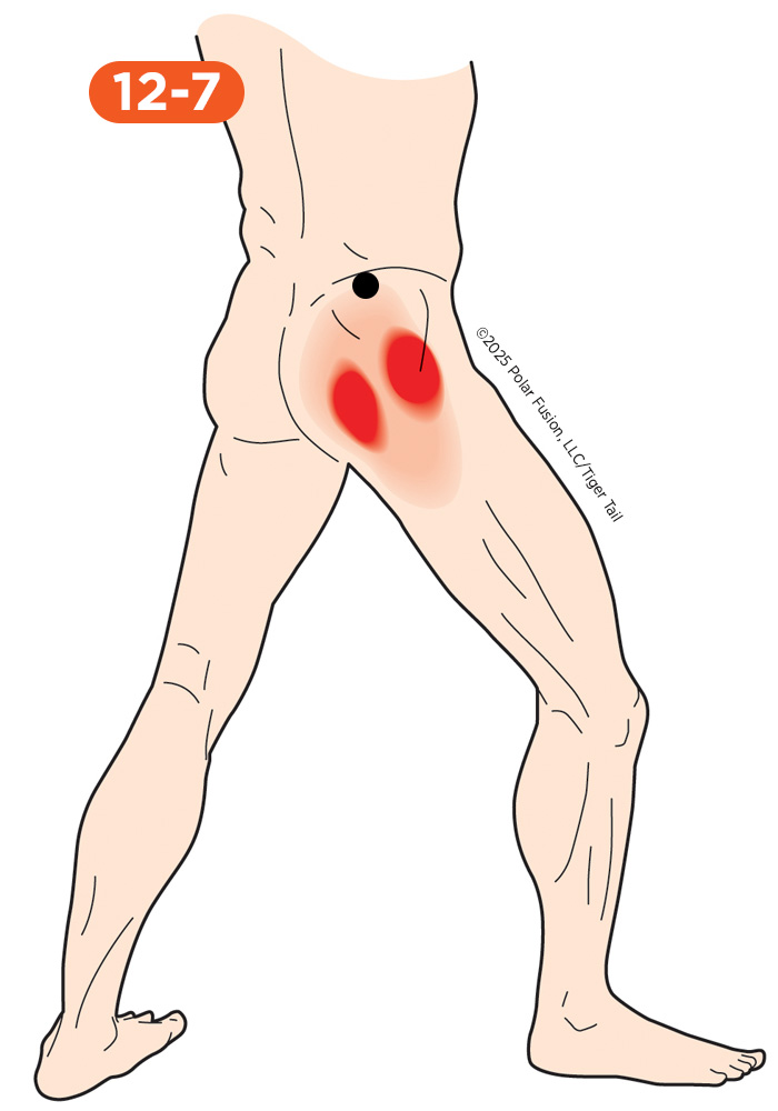 Glute Pain 12-7 Gluteus Medius