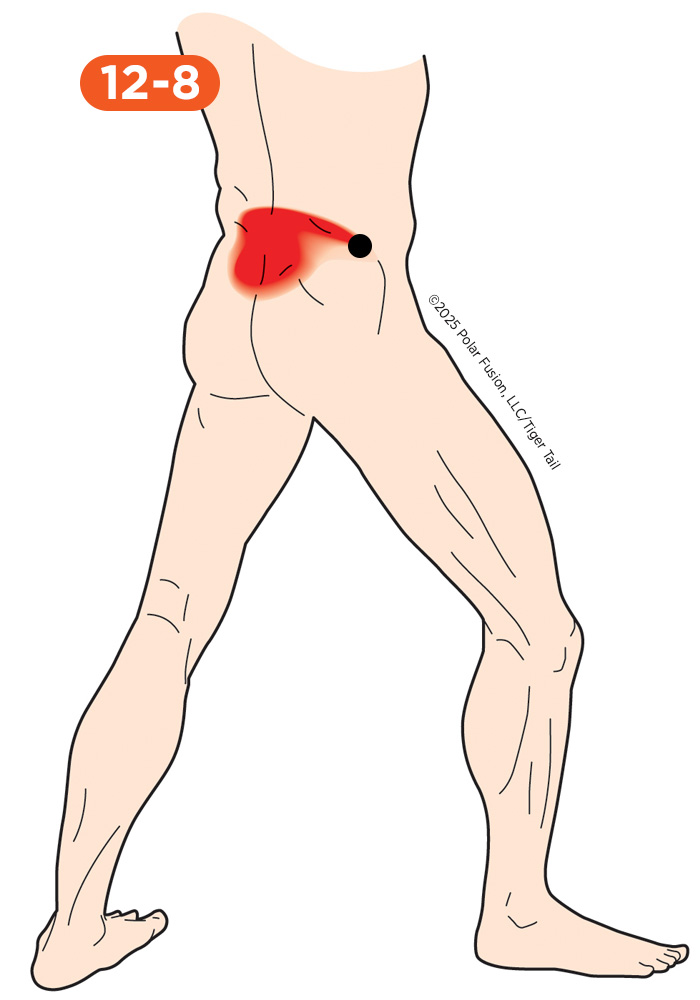 Glute Pain 12-8 Gluteus Medius