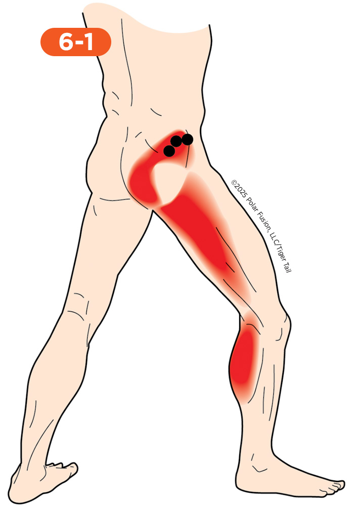 Hamstring Pain 6-1 Gluteus Minimus Posterior Portion