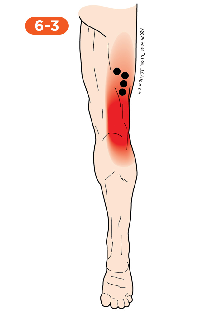 Hamstring Pain 6-3 Biceps Femoris