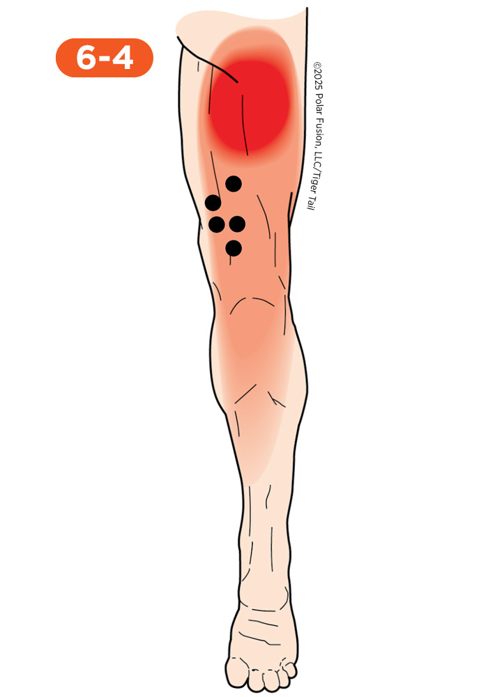 Hamstring Pain 6-4 Semitendinosus Semimembranosus