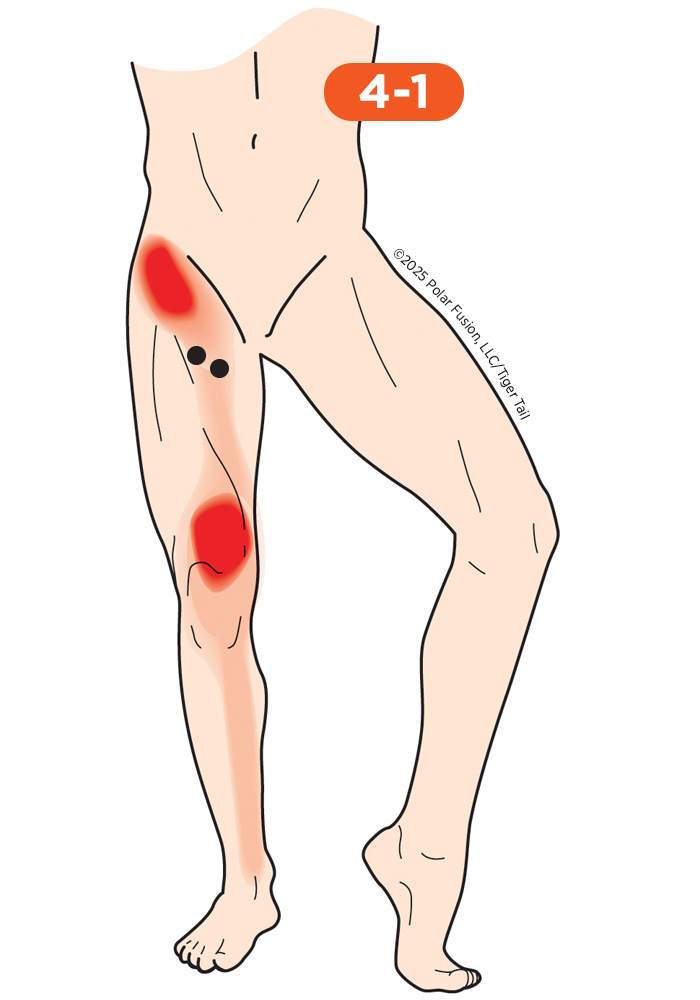 HipFlexor_4-1_AdductorBrevis_AdductorLongus Hip Flexor Pain 4-1 Adductor Brevis Adductor Longus