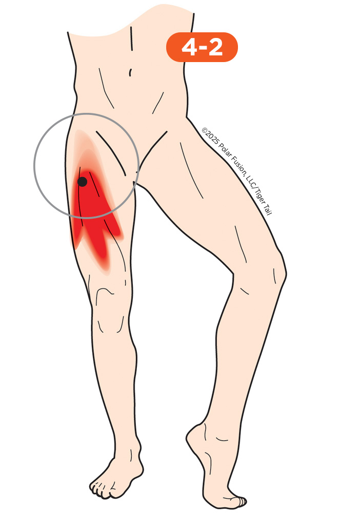 HipFlexor_4-2_VastusIntermedius Hip Flexor Pain 4-2 Vastus Intermedius