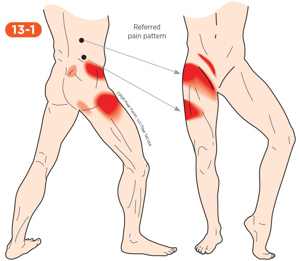 Hip Pain 13-1 Quadratus Lumborum