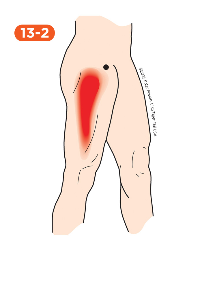 Hip Pain 13-2 Tensor Fasciae Latae