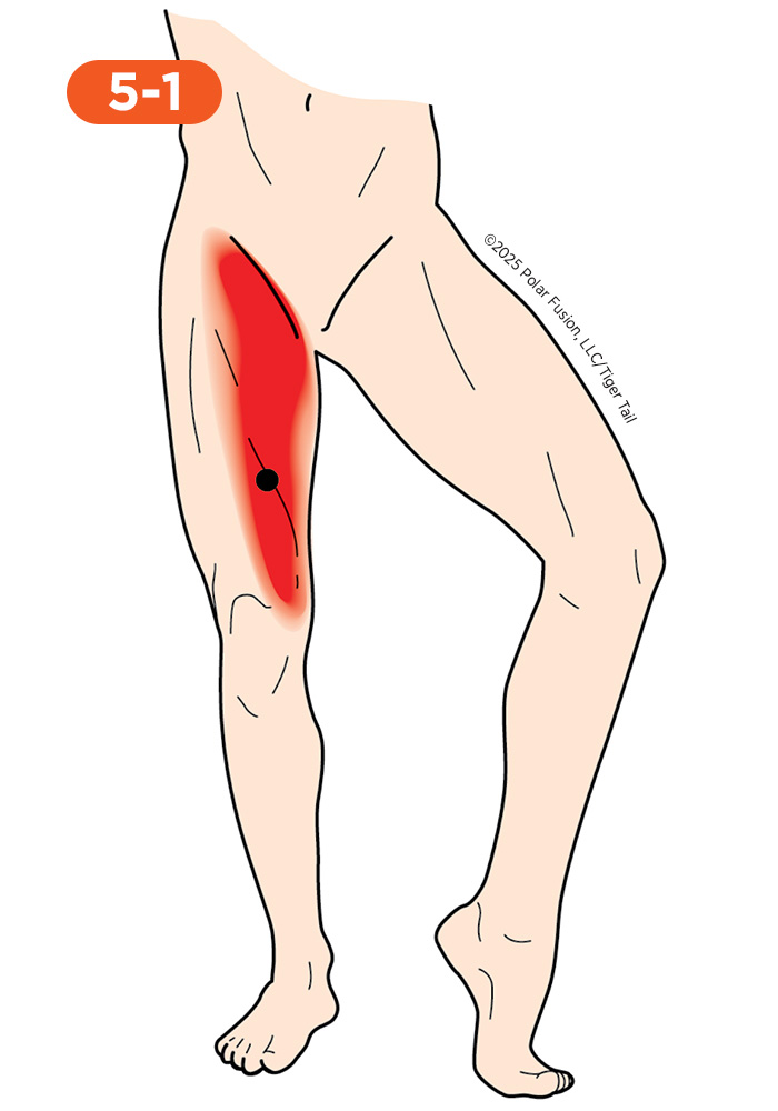 Inner Leg and Groin Pain 5-1 Adductor Magnus