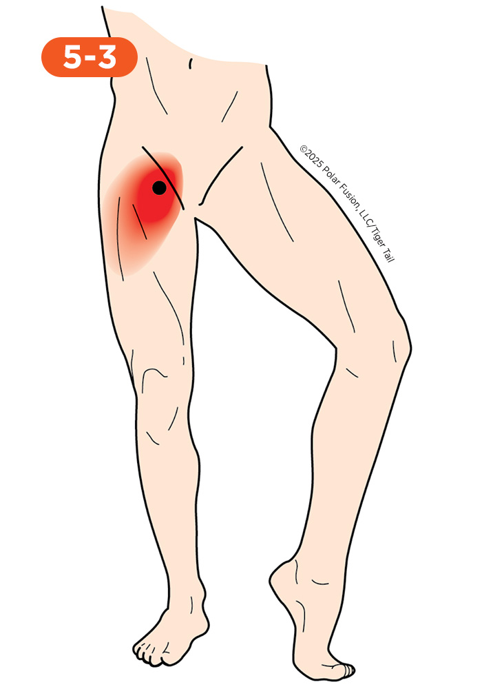 Inner Leg and Groin Pain 5-3 Pectineus