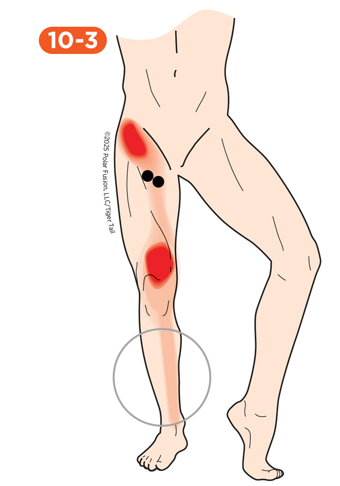 Shin Pain 10-3 Adductor Longus