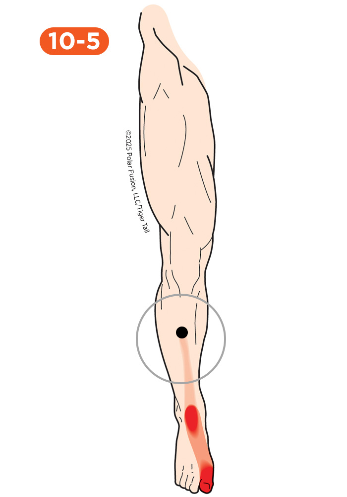 Shin Pain 10-5 Tibialis Anterior