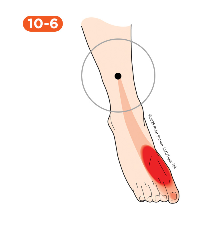 Shin Pain 10-6 Extensor Hallucis Longus