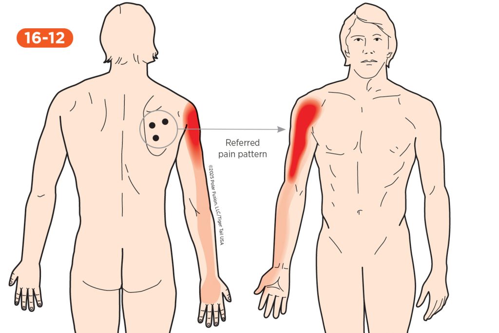 Shoulder Pain 16-12 Infraspinatus