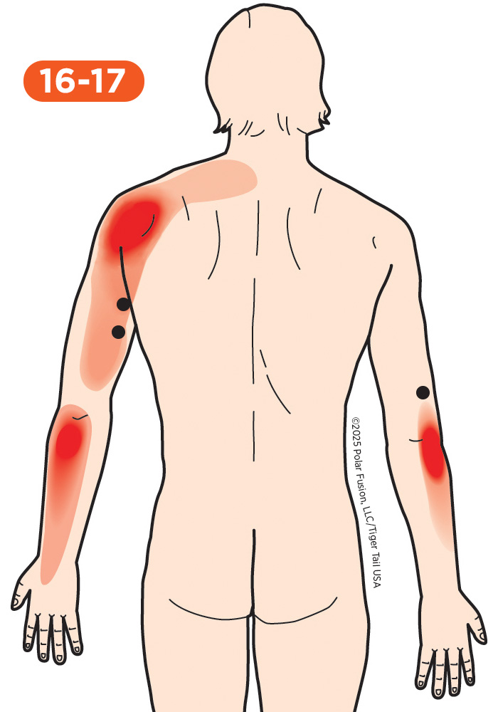 Shoulder Pain 16-17 Triceps Brachii