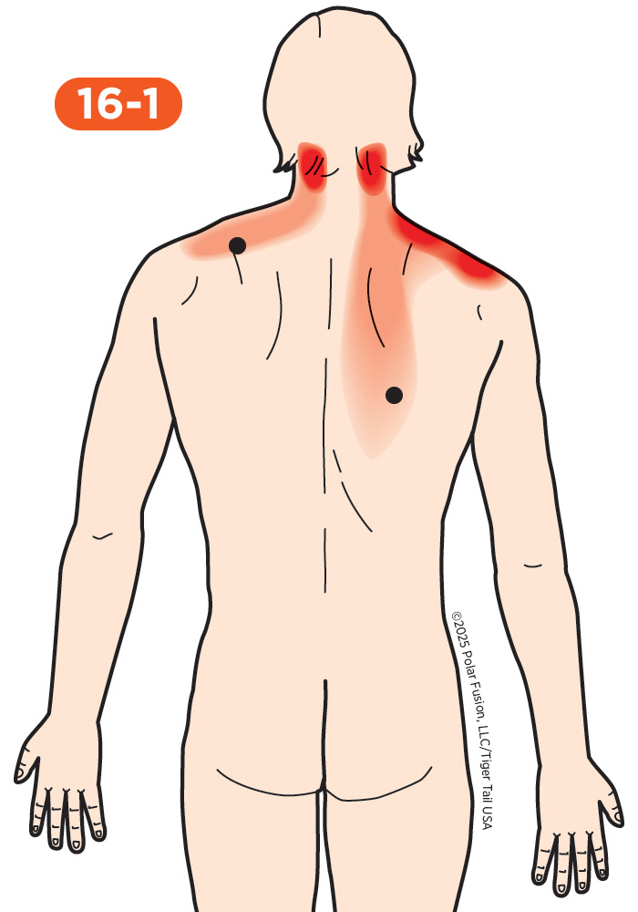 Shoulder Pain 16-1 Trapezius