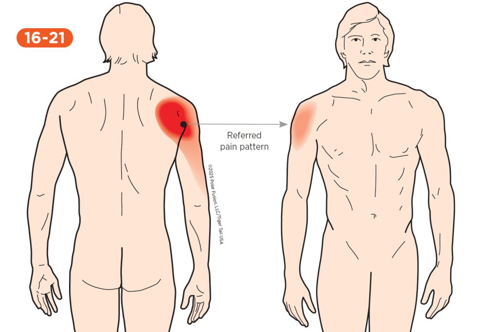 Shoulder Pain 16-21 Deltoid Posterior