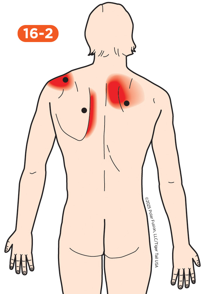 Shoulder Pain 16-2 Trapezius