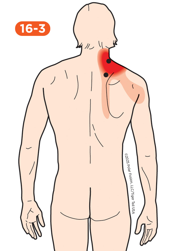 Shoulder Pain 16-3 Levator Scapulae