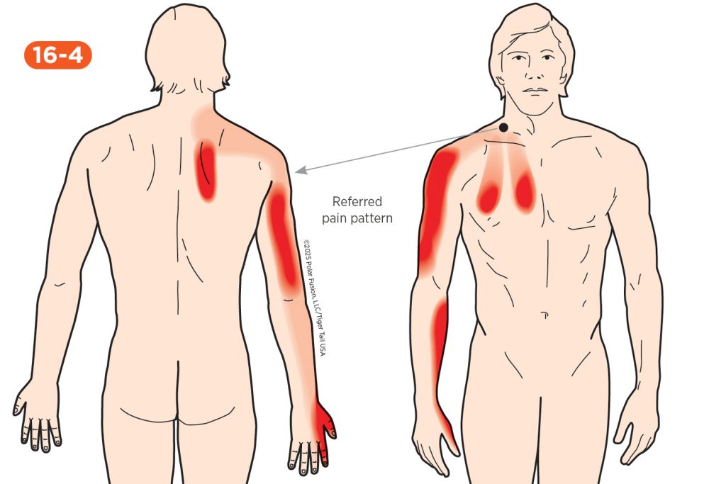 Shoulder Pain 16-4 Scaleni
