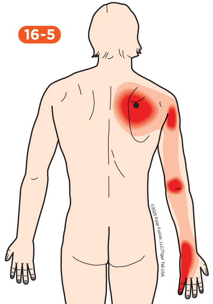 Shoulder Pain 16-5 Serratus Posterior Superior
