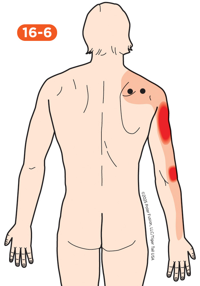 Shoulder Pain 16-6 Supraspinatus