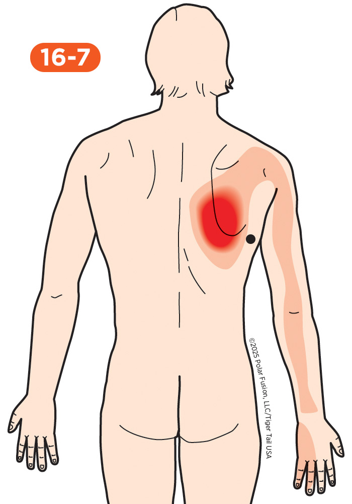 Shoulder Pain 16-7 Latissimus Dorsi