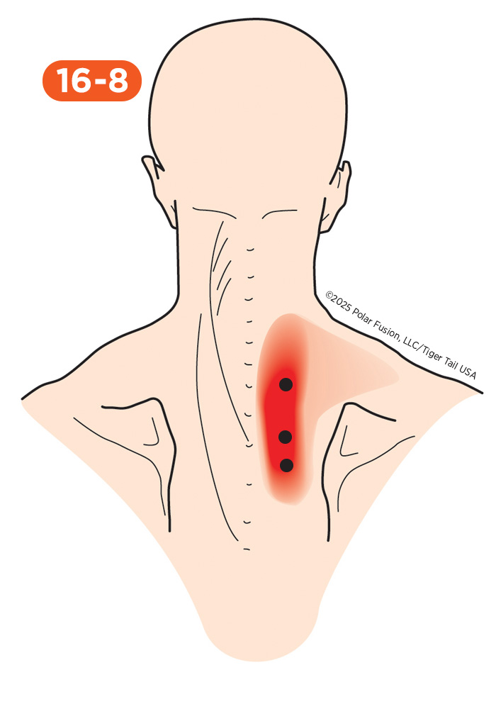 Shoulder Pain 16-8 Rhomboideus