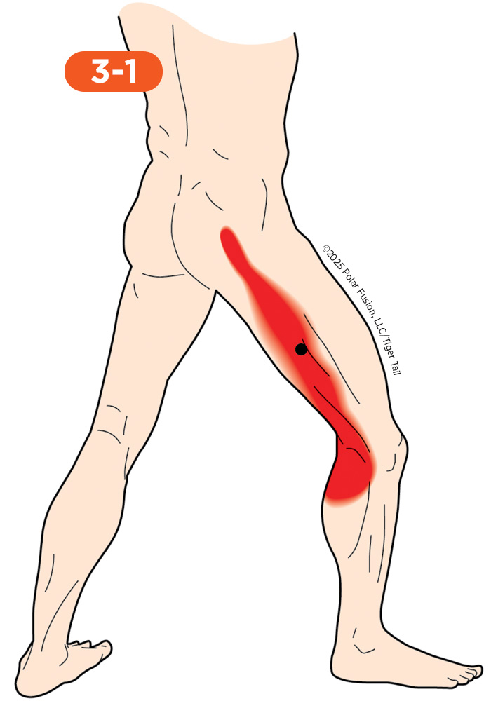 Side of Leg Pain 3-1 Vastus Lateralis