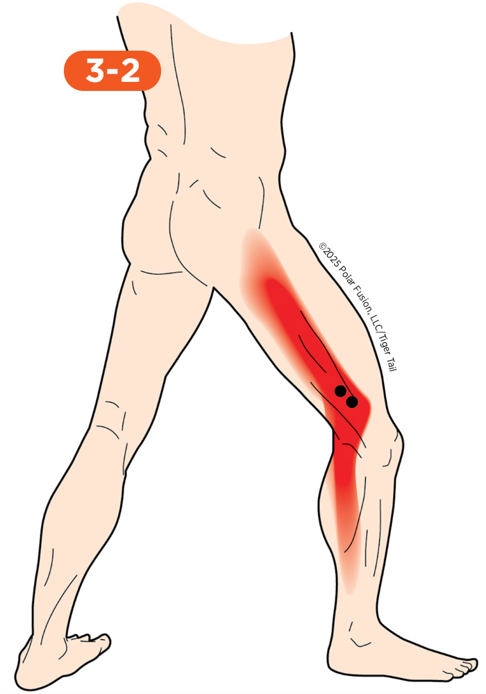 Side of Leg Pain 3-2 Vastus Lateralis