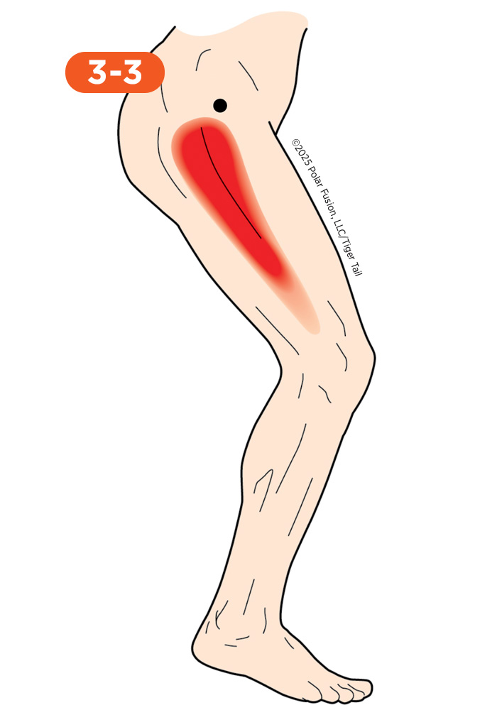 Side of Leg Pain 3-3 Tensor Fascia Latae