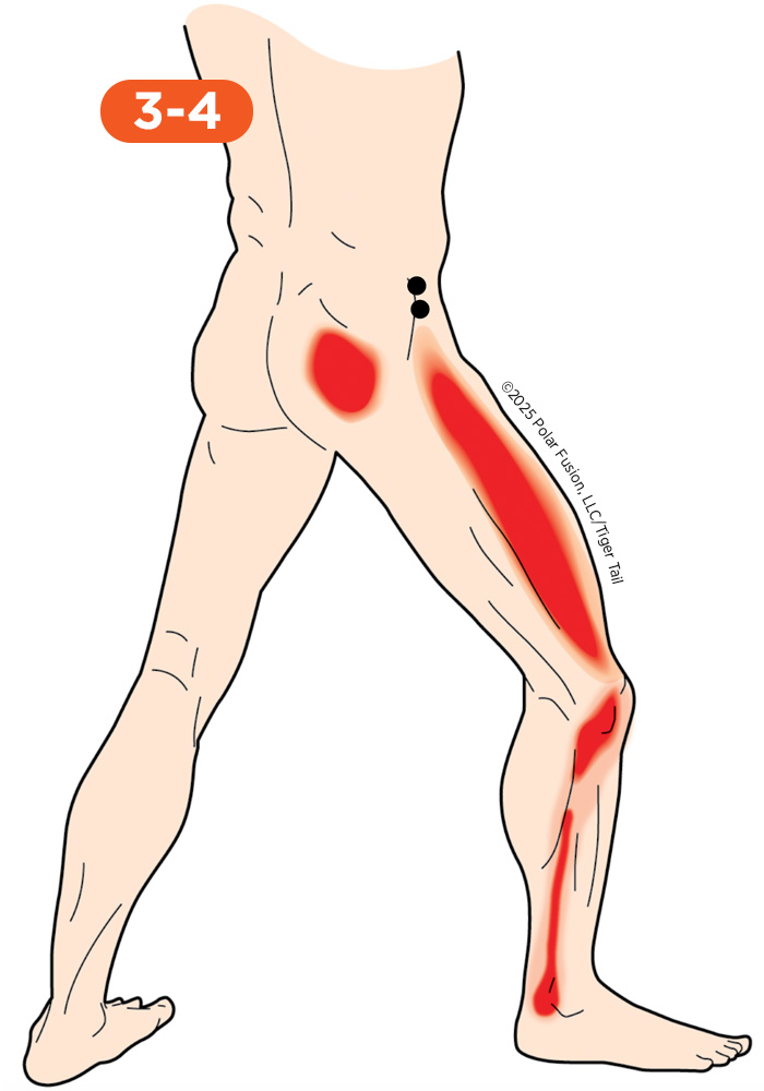 Side of Leg Pain 3-4 Glute Minimis Anterior Portion