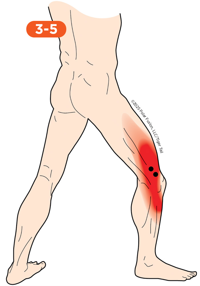 Side of Leg Pain 3-5 Vastus Lateralis