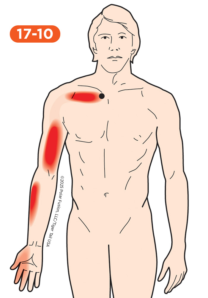 Forearm Pain 17-10 Subclavius