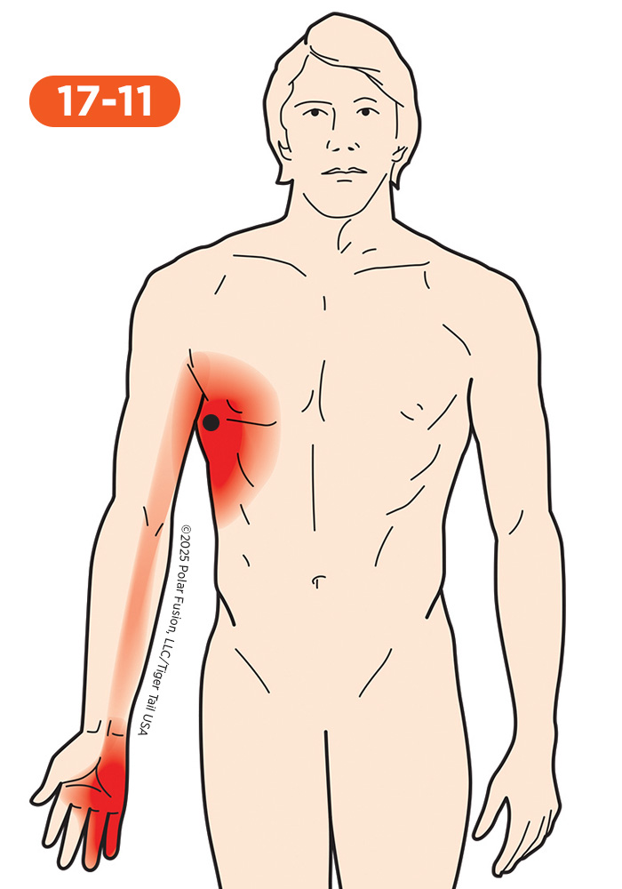 Forearm Pain 17-11 Serratus Anterior