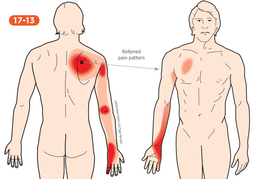 Forearm Pain 17-13 Serratus Posterior Superior
