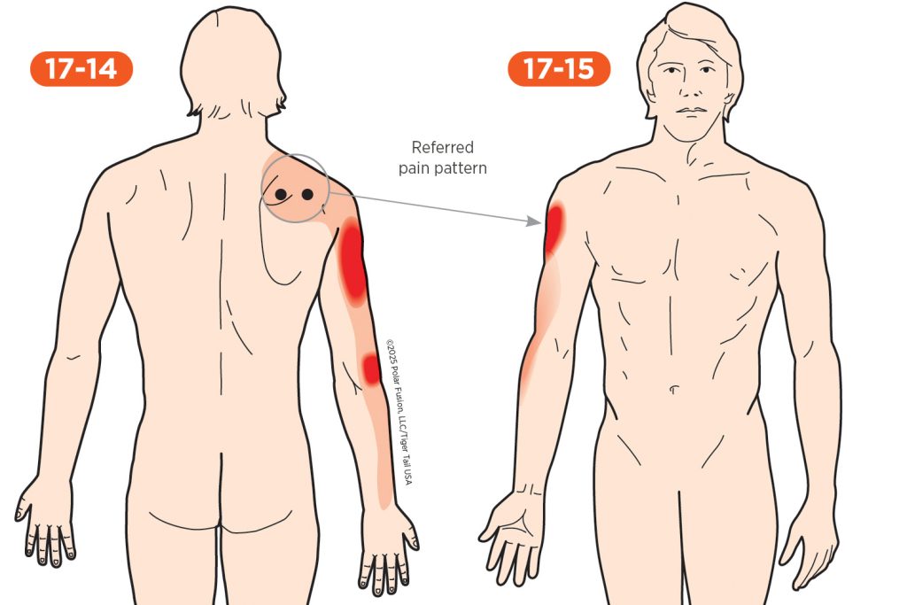 Forearm Pain 17-14 Supraspinatus
