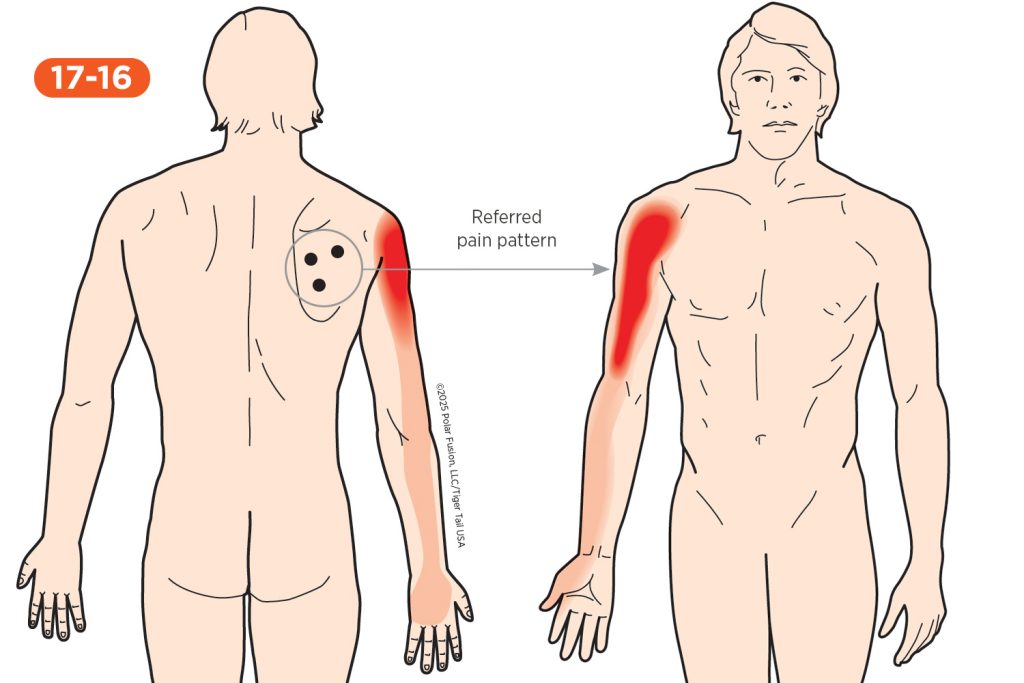 Forearm Pain 17-16 Infraspinatus