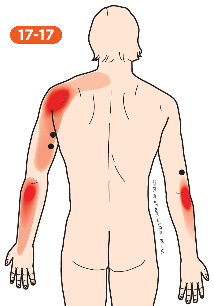 Upper Arm Pain 17-17 Triceps Brachii
