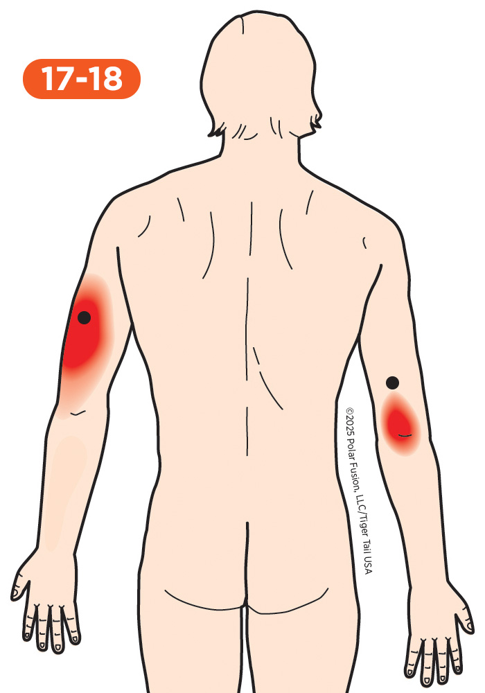 Upper Arm Pain 17-18 Triceps Brachii