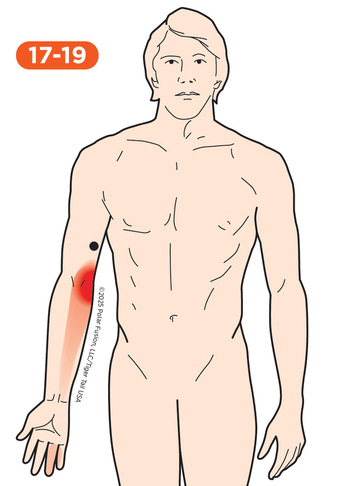 Upper Arm Pain 17-19 Triceps Brachii