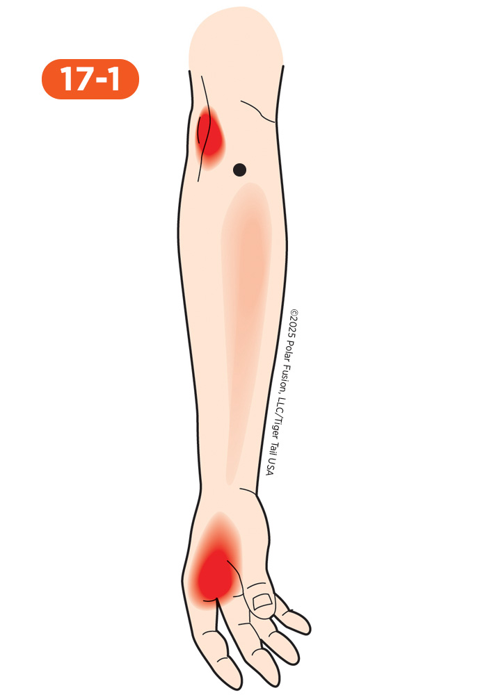Forearm Pain 17-1 Brachioradialis