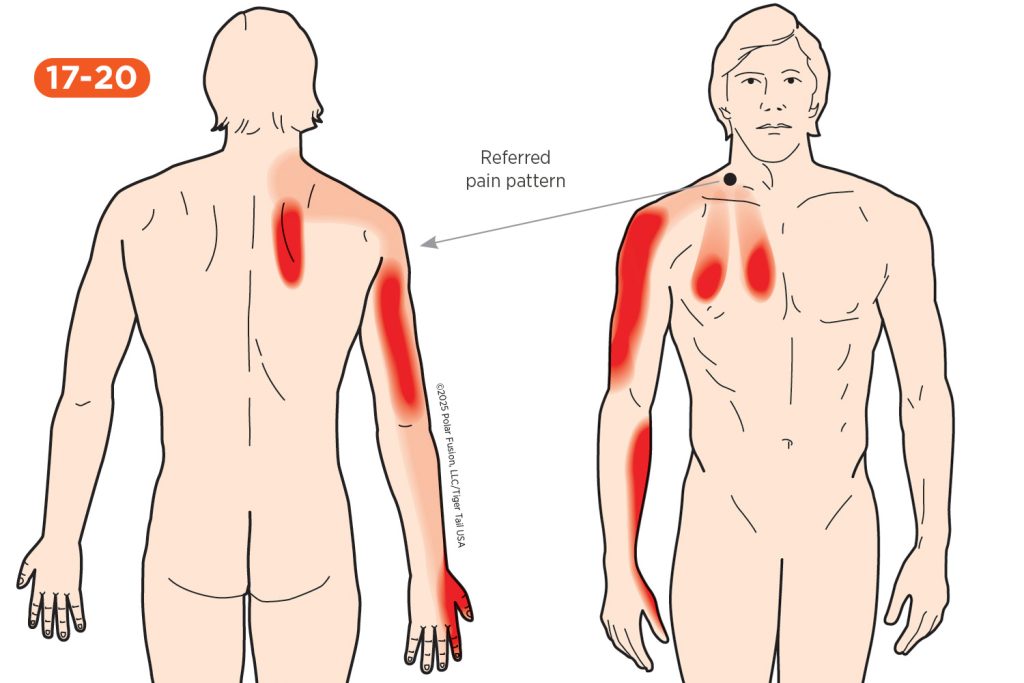 Upper Arm Pain 17-20_Scaleni
