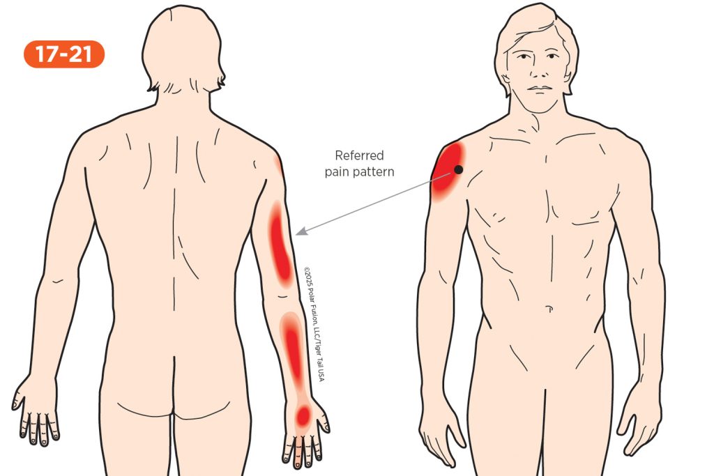 Upper Arm Pain 17-21 Coracobrachialis