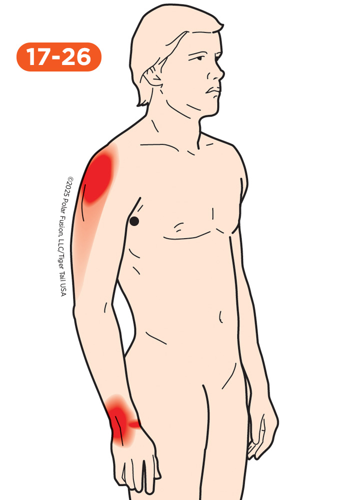 Upper Arm Pain 17-26 Subscapularis