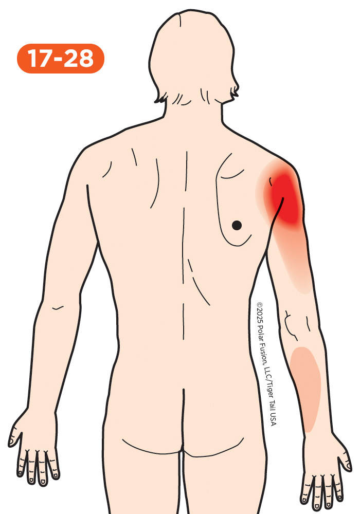 Upper Arm Pain 17-28 Teres Major