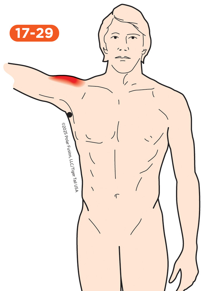 Upper Arm Pain 17-29 Teres Major