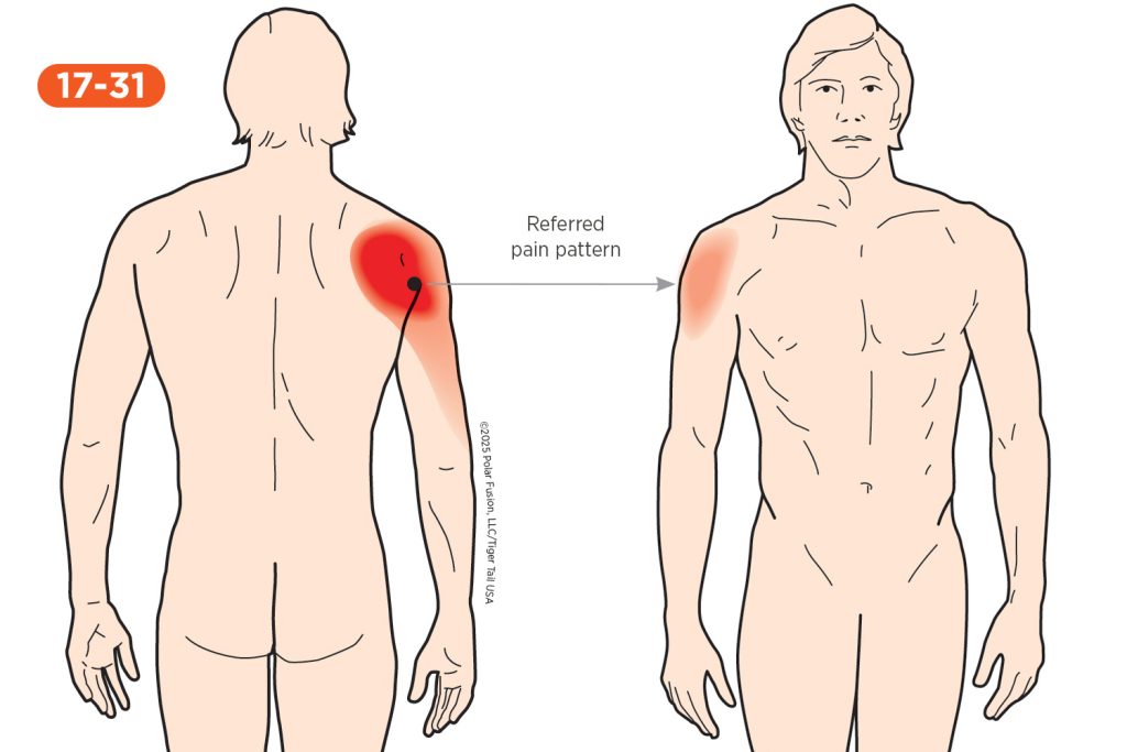 Upper Arm Pain 17-31 Deltoid