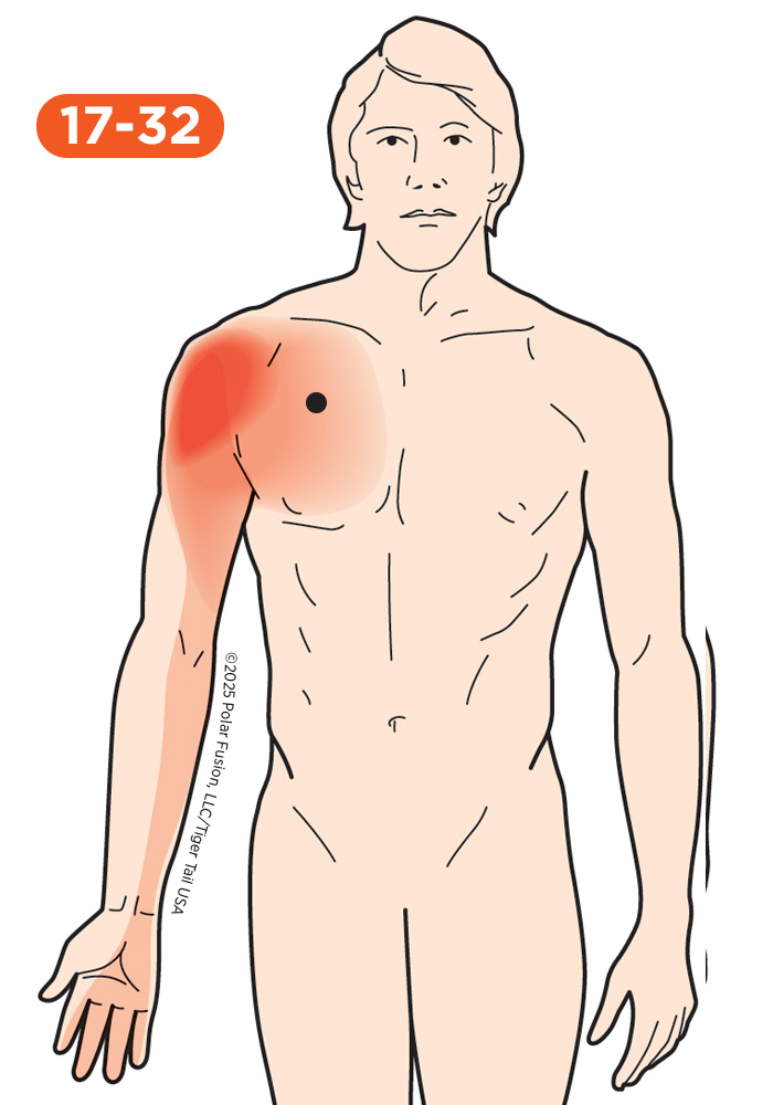 Upper Arm Pain 17-32 Pectoralis Minor