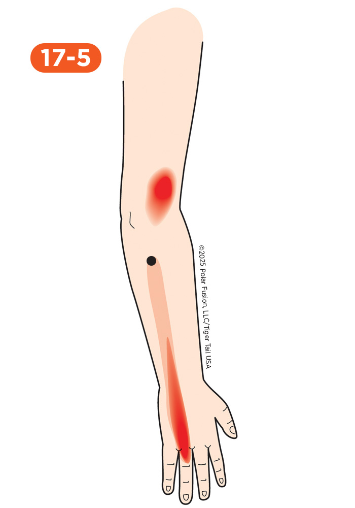 Forearm 17-5 Ring Finger Extensor