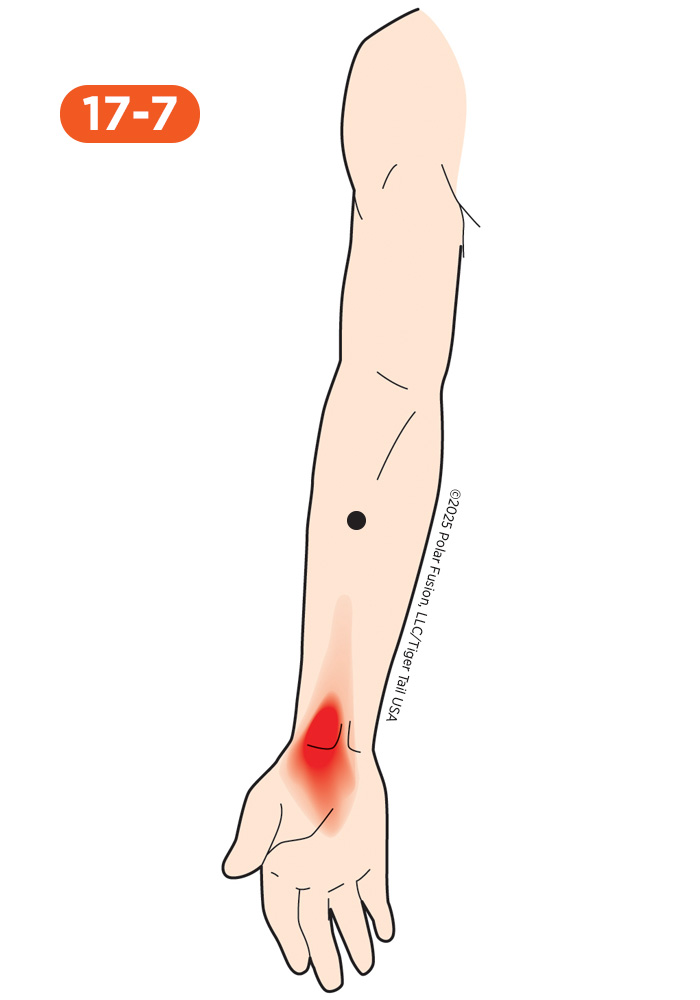 Forearm Pain 17-7 Flexor Carpi Radialis