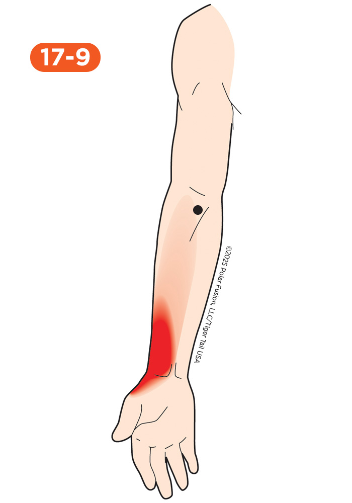 Forearm Pain 17-9 Pronator Teres